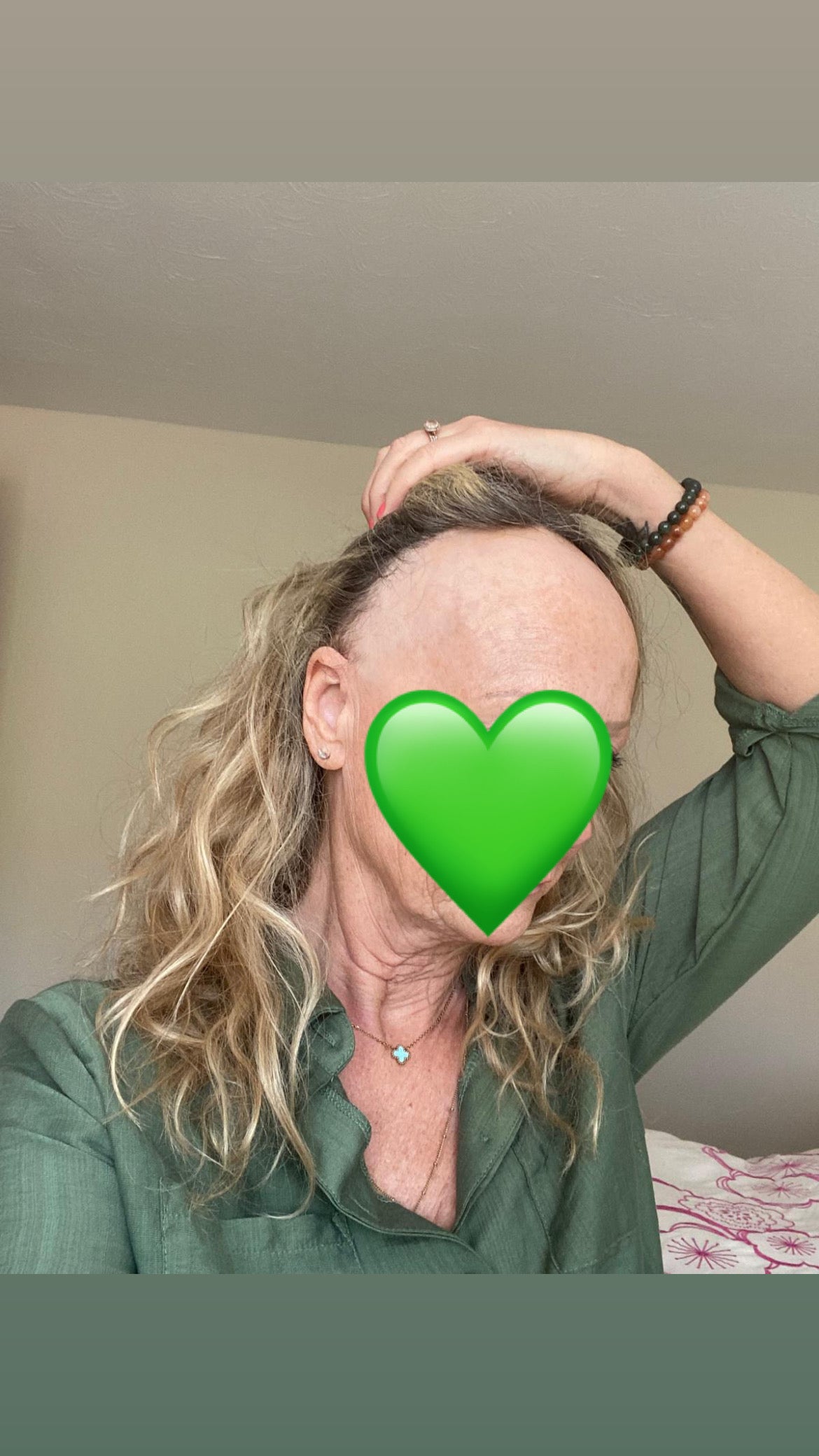 Hairline Frontal